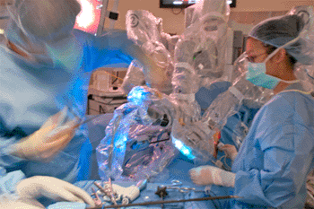 Image: The operation to relieve the symptoms of achalasia involves opening up the esophageal sphincter muscle. When the muscle is properly opened, it will allow food to pass forward. In order to help prevent acid from refluxing backward, causing esophageal reflux or GERD, a partial fundoplication is usually performed at the end of the procedure (Photo courtesy of Laparoscopic.md). Image: The operation to relieve the symptoms of achalasia involves opening up the esophageal sphincter muscle. When the muscle is properly opened, it will allow food to pass forward. In order to help prevent acid from refluxing backward, causing esophageal reflux or GERD, a partial fundoplication is usually performed at the end of the procedure (Photo courtesy of Laparoscopic.md).